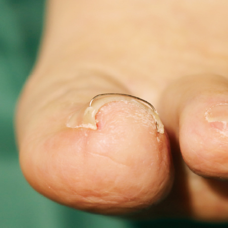 ワイヤーを装着